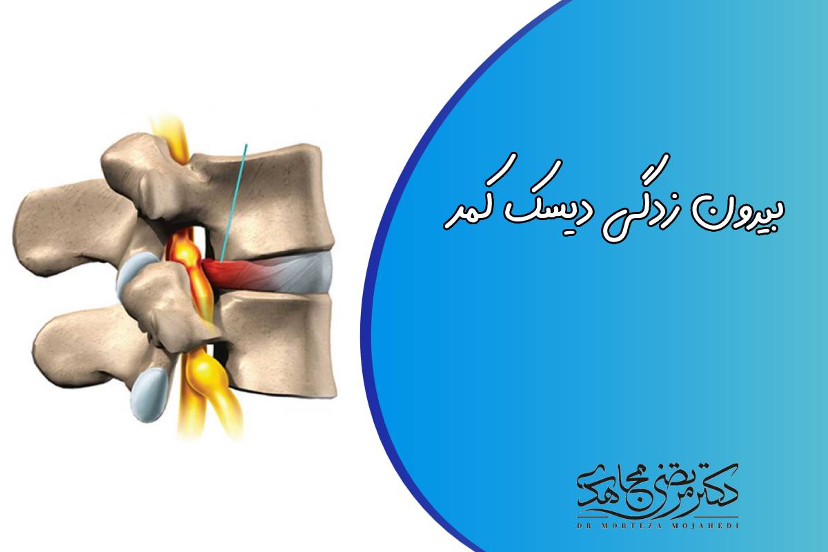 کمردرد: بیرون زدگی دیسک