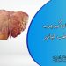 درمان کبد چرب در طب ایرانی